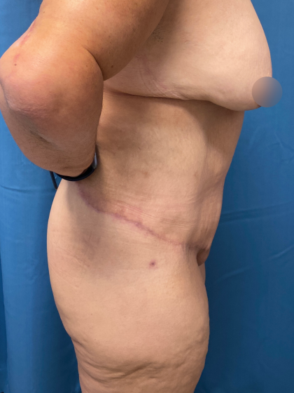 Lower Body Lift Before & After Patient #11438