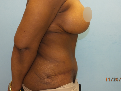 Tummy Tuck Before & After Patient #10950