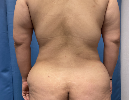 Tummy Tuck Before & After Patient #10937