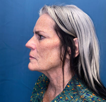 Facelift and Necklift Before & After Patient #11447