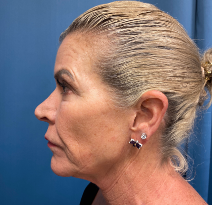 Lip Lift Before & After Patient #11448