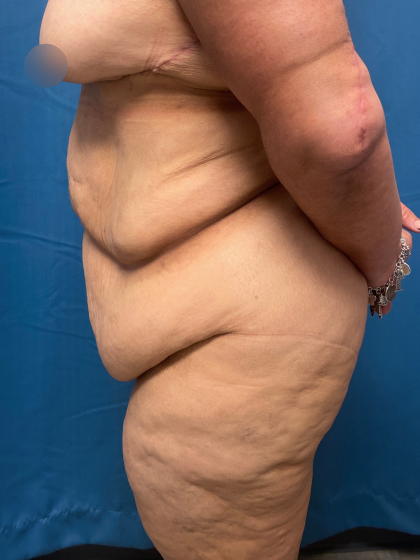 Lower Body Lift Before & After Patient #11438