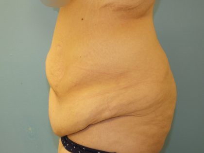 Tummy Tuck Before & After Patient #11013