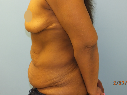 Tummy Tuck Before & After Patient #10950
