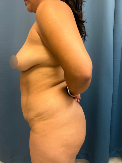 Tummy Tuck Before & After Patient #11441