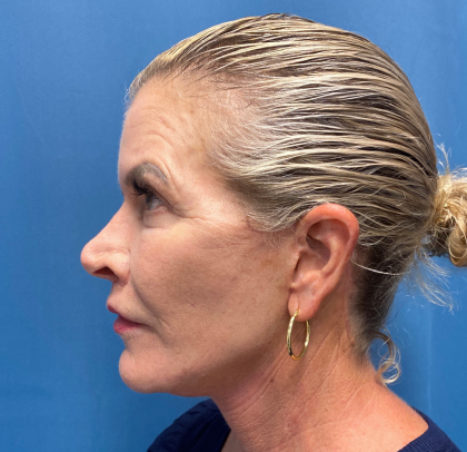 Lip Lift Before & After Patient #11448