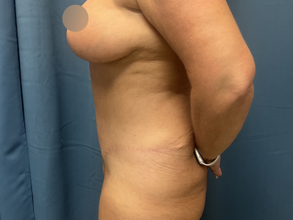 Tummy Tuck Before & After Patient #10926