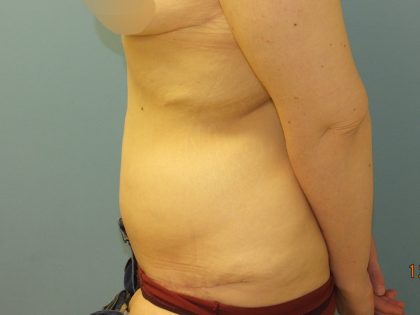 Tummy Tuck Before & After Patient #11013