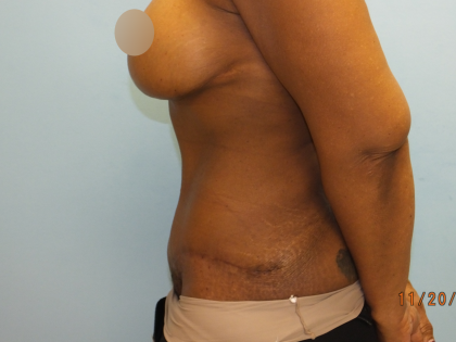 Tummy Tuck Before & After Patient #10950