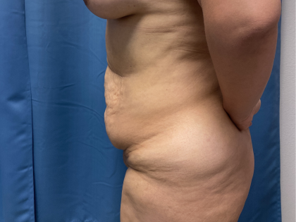 Tummy Tuck Before & After Patient #10937