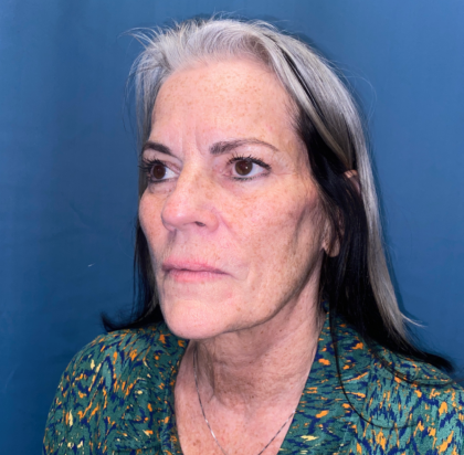 Facelift and Necklift Before & After Patient #11447