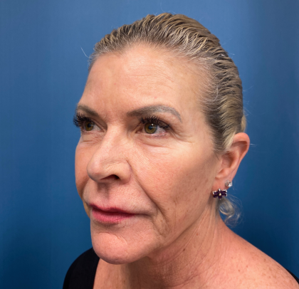 Lip Lift Before & After Patient #11448