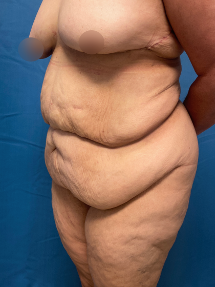 Lower Body Lift Before & After Patient #11438