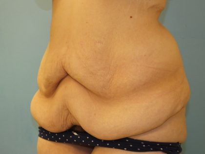 Tummy Tuck Before & After Patient #11013