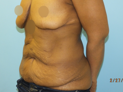 Tummy Tuck Before & After Patient #10950
