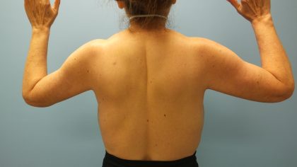 Arm Lift Before & After Patient #10920