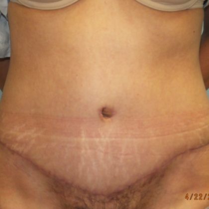 Tummy Tuck Before & After Patient #11024