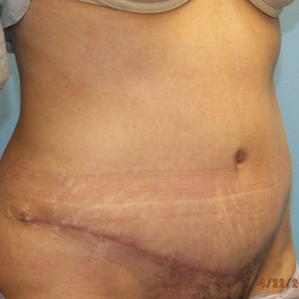Tummy Tuck Before & After Patient #11024