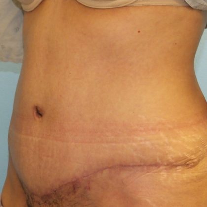 Tummy Tuck Before & After Patient #11024