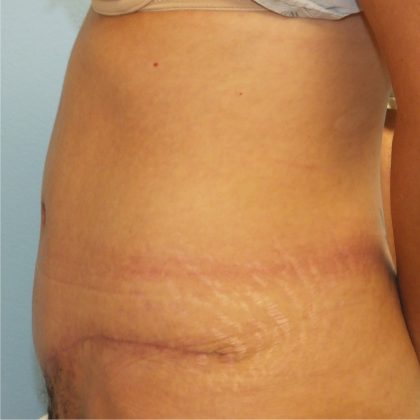 Tummy Tuck Before & After Patient #11024