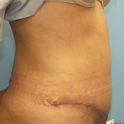 Tummy Tuck Before & After Patient #11024