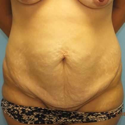 Tummy Tuck Before & After Patient #11024