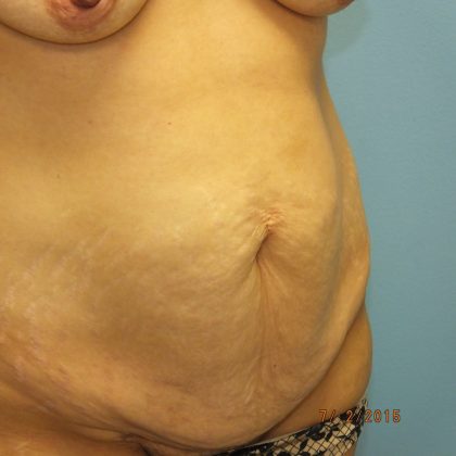 Tummy Tuck Before & After Patient #11024