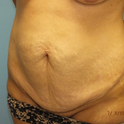 Tummy Tuck Before & After Patient #11024