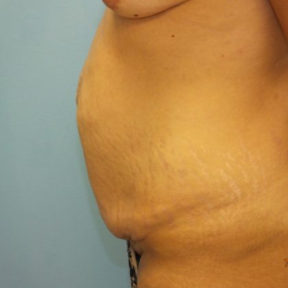 Tummy Tuck Before & After Patient #11024