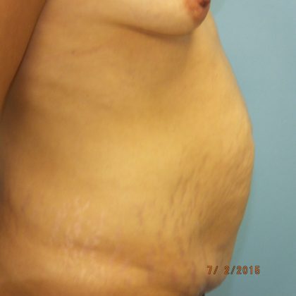 Tummy Tuck Before & After Patient #11024