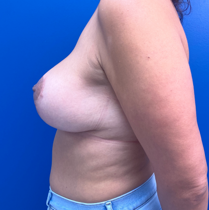Breast Lift/Mastopexy Before & After Patient #11849
