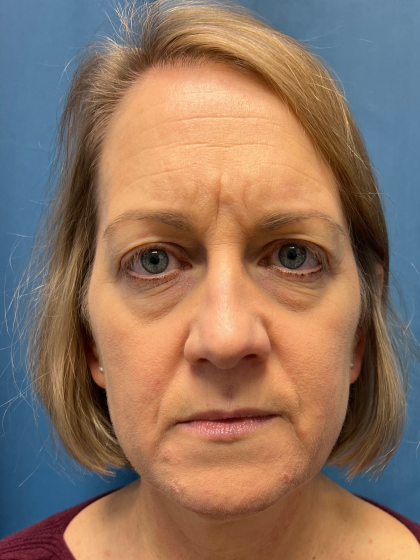 Blepharoplasty Before & After Patient #11965