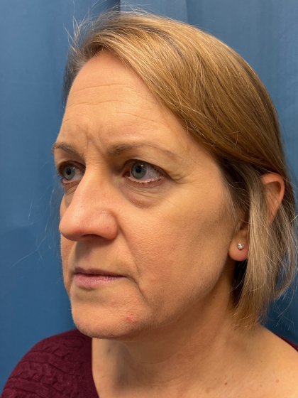 Blepharoplasty Before & After Patient #11965