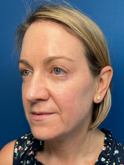 Blepharoplasty Before & After Patient #11965