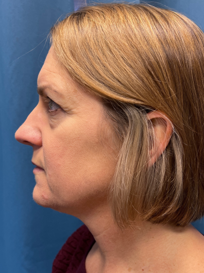 Blepharoplasty Before & After Patient #11965