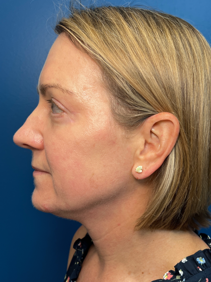 Blepharoplasty Before & After Patient #11965