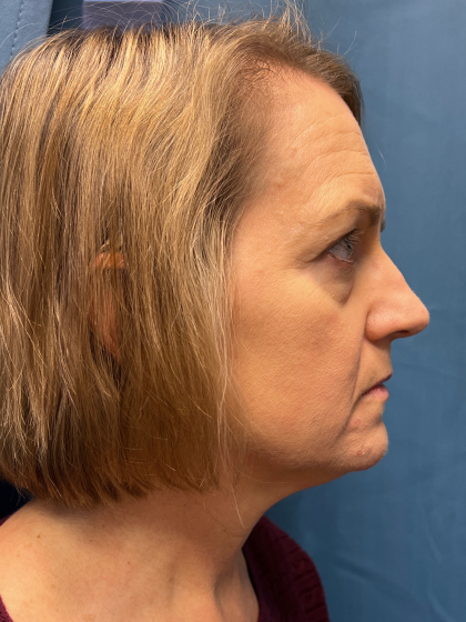 Blepharoplasty Before & After Patient #11965