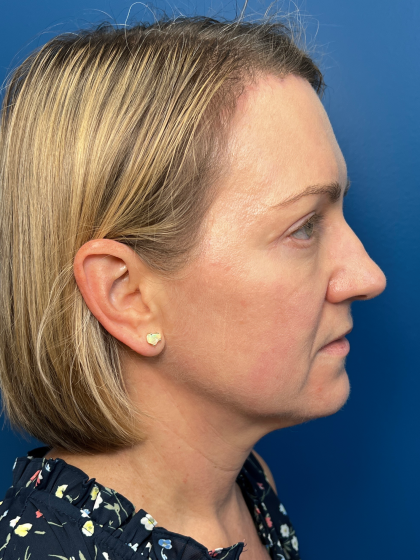 Blepharoplasty Before & After Patient #11965