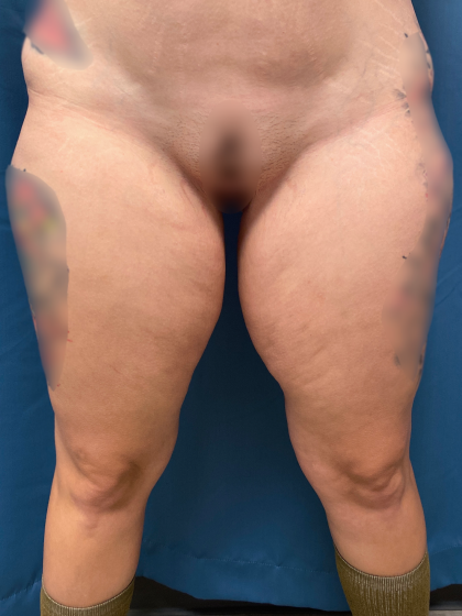 Thigh Lift Before & After Patient #12179