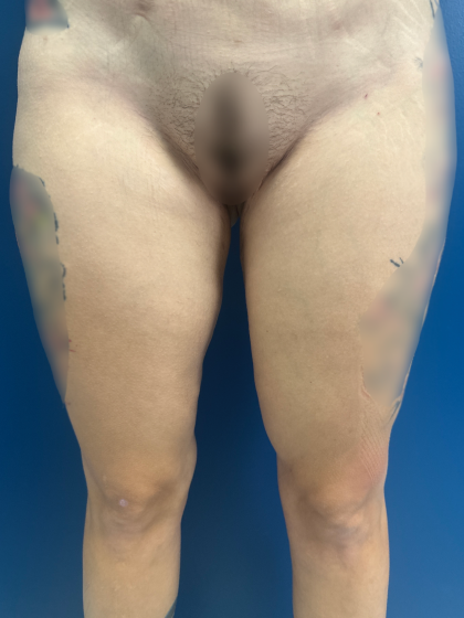 Thigh Lift Before & After Patient #12179