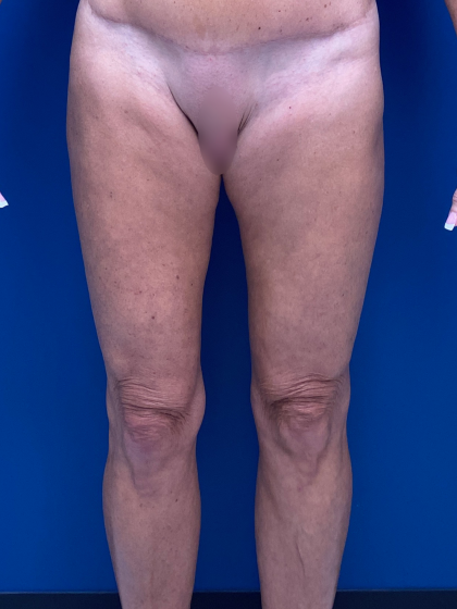 Thigh Lift Before & After Patient #12178