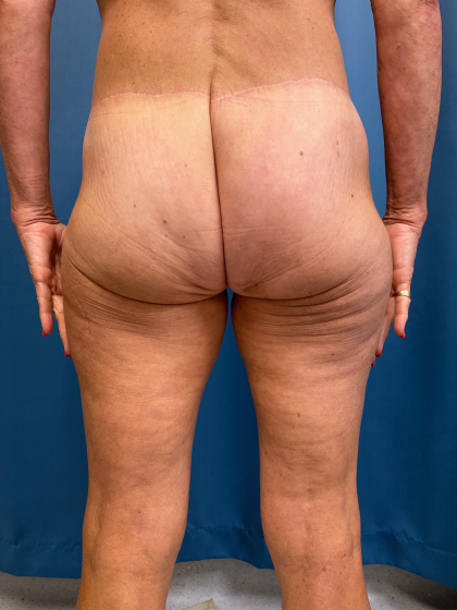 Thigh Lift Before & After Patient #12178