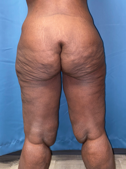 Thigh Lift Before & After Patient #12180