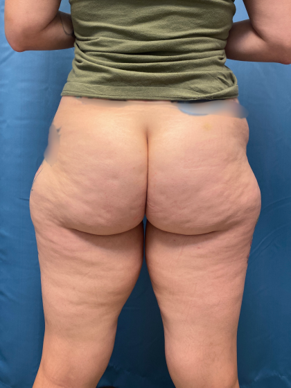 Thigh Lift Before & After Patient #12179