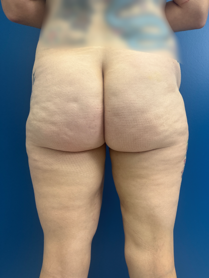 Thigh Lift Before & After Patient #12179