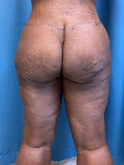 Thigh Lift Before & After Patient #12180
