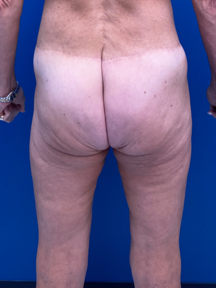 Thigh Lift Before & After Patient #12178