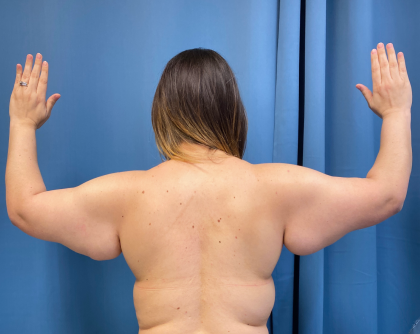 Arm Lift Before & After Patient #12347