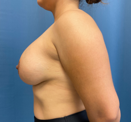 Breast Augmentation Before & After Patient #12354