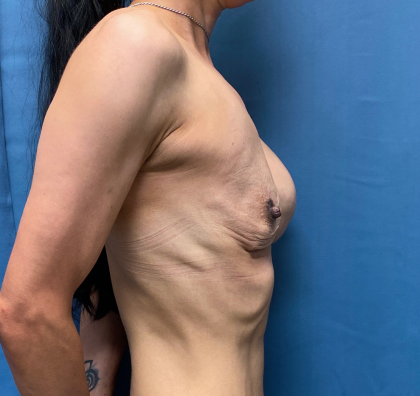 Breast Revision Before & After Patient #12348